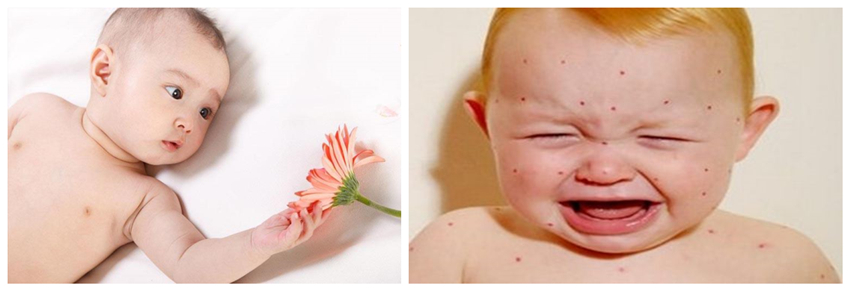 兒童濕疹反反復復，您有在家安裝家用除濕產品嗎？